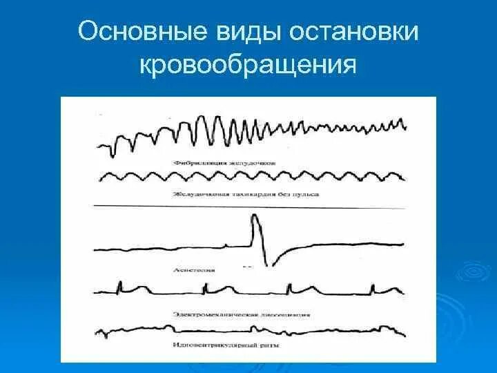 Виды остановки кровообращения. Виды остановки кровообращения реаниматология. Основной вид остановки кровообращения. ЭКГ при остановке кровообращения.