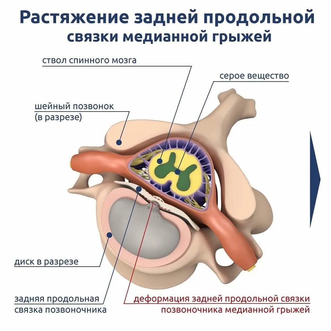 Кровоснабжение межпозвоночных дисков. Медианная грыжа. Позвонок в разрезе. Медианно-парамедианная грыжа. Протрузия экструзия грыжа.