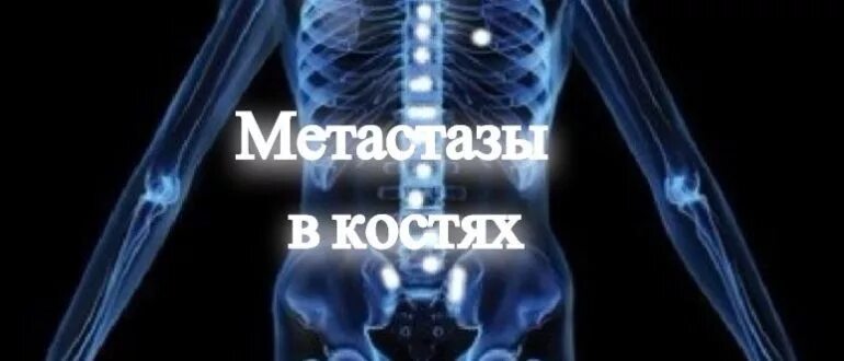 Фото ОСТЕОЛИТИЧЕСКИЕ МЕТАСТАЗЫ
