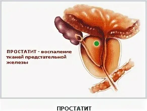 Семенной бугорок предстательной железы. Воспаление семенного бугорка. Простатит рисунок. Семенной бугорок у мужчин. Ткань простаты