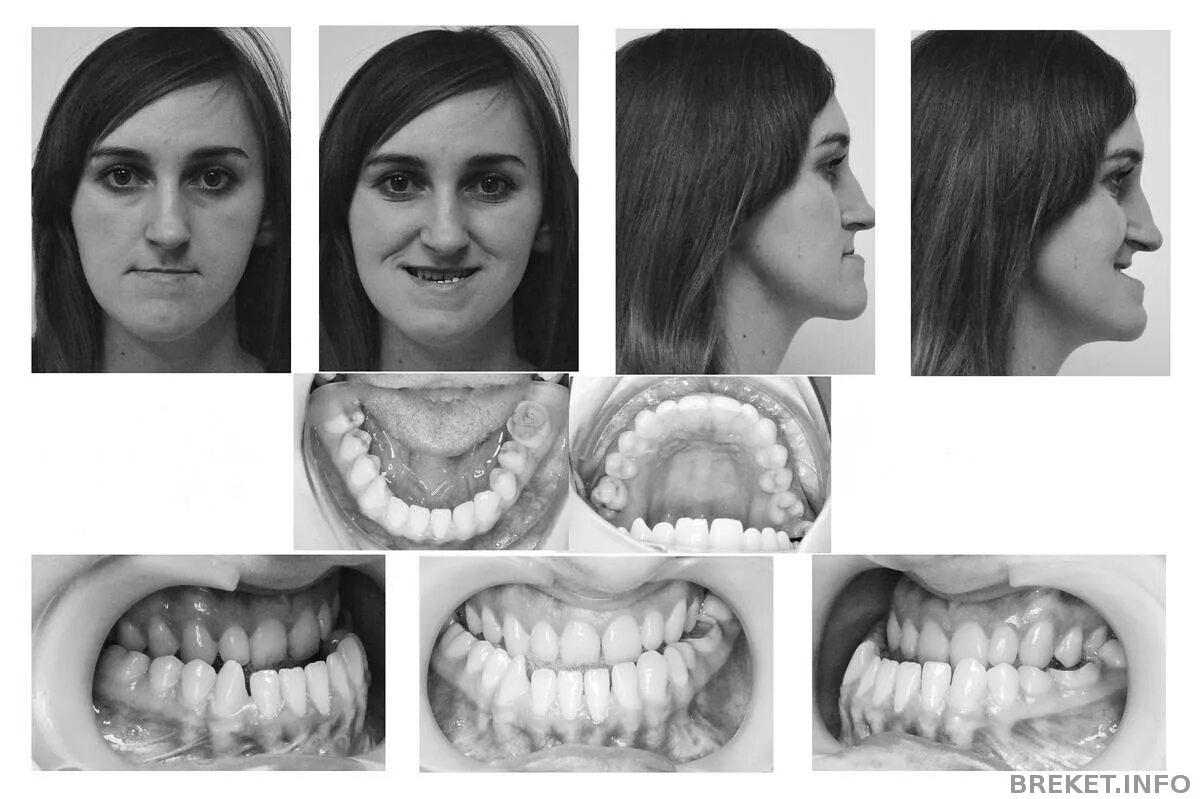 Удлиненная челюсть. Дистальный мезиальный профиль. Мезиальный прикус наследственность. Скученность мезиальный прикус брекеты.