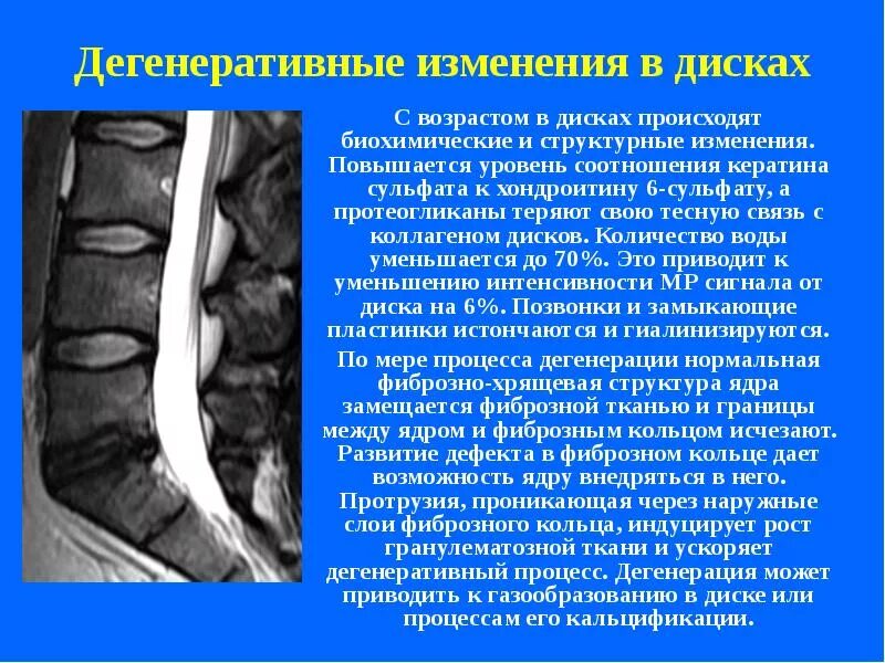 Начальные дистрофические изменения крестцово. Дегенеративно-дистрофические изменения позвоночника мрт. Дегенеративные изменения поясничного отдела позвоночника. Дистрофические изменения шейного позвоночника. Дегенеративное извинения позвоночника.