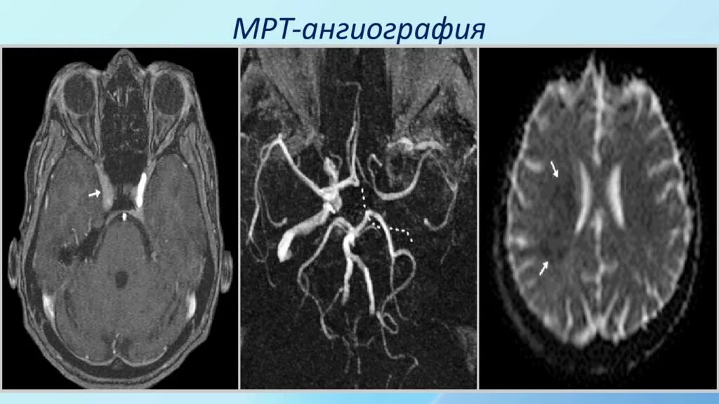 Ишемия мозга мрт. Ишемический инсульт кт ангиография. Кт ангиография при ишемическом инсульте. Ишемический инсульт на кт головного мозга. Ишемический инсульт мрт снимок.