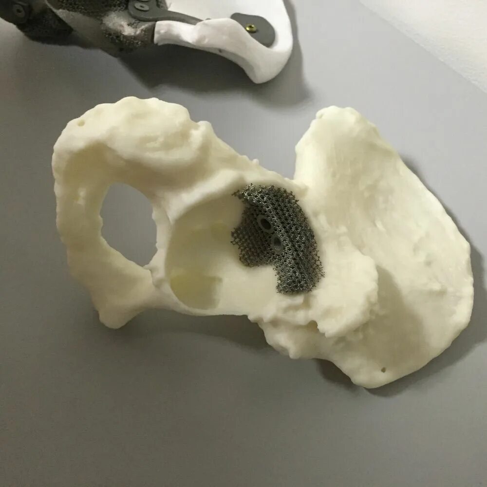 Titanium implants