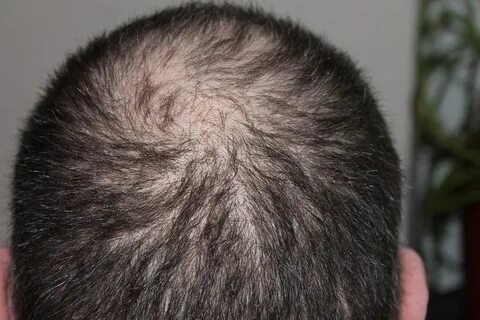 Что делать когда выпадают волосы
