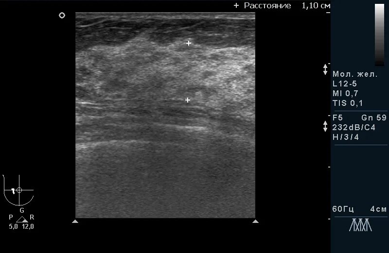 Узловая мастопатия молочной железы на УЗИ. Узловая форма мастопатии на УЗИ. УЗИ молочных желез с лимфоузлами. УЗИ молочных желез показания.