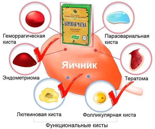 Лекарство при кисте яичника. Таблетки пр кисти яичнека. Таблетки при кисте яичника. Препараты при функциональной кисте яичника. Можно с кистой в баню