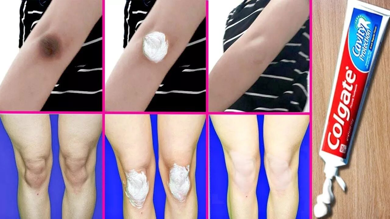 Как избавиться от темных локтей