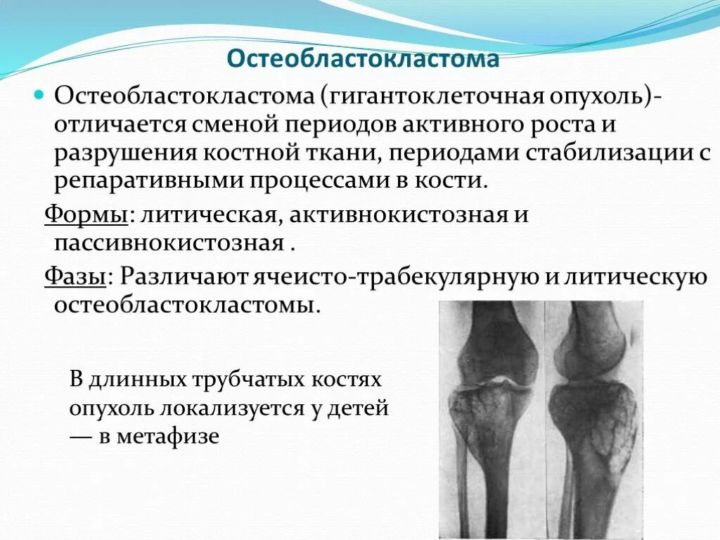 Гигантоклеточная опухоль большеберцовой кости кт. Доброкачественная опухоль кости рентген. Гигантоклеточная опухоль лечение. Гигантоклеточная опухоль большеберцовой кости. Гигантоклеточная опухоль кости клинические рекомендации.