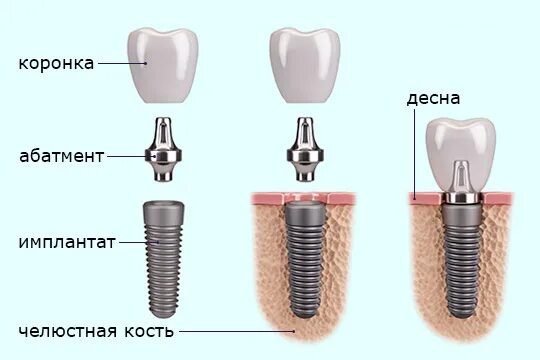 Как выглядит формирователь десны. Коронка абатмент формирователь. формирователь десны tsha403m. формирователь десны и абатмент. имплант зубов формирователь.