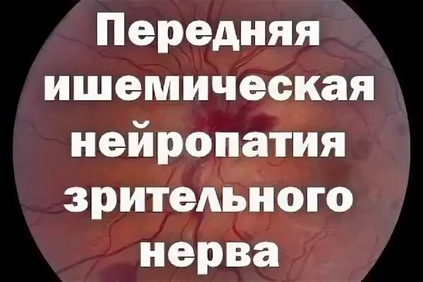 Нейропатия зрительного нерва. Передняя ишемическая нейрооптикопатия. Передняя ишемическая нейропатия зрительного нерва. Неартериальная передняя ишемическая оптическая нейропатия. Передняя ишемическая нейропатия