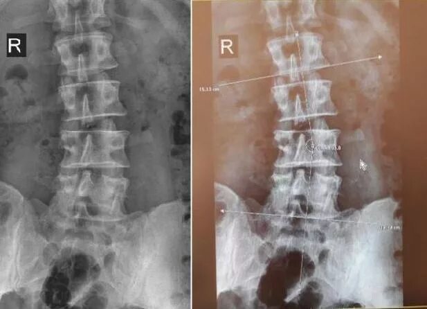 Сакрализация l5 позвонка рентген. Сакрализация l5 рентген. Люмбализация с1. Рентгенография позвоночника в 2 х проекциях