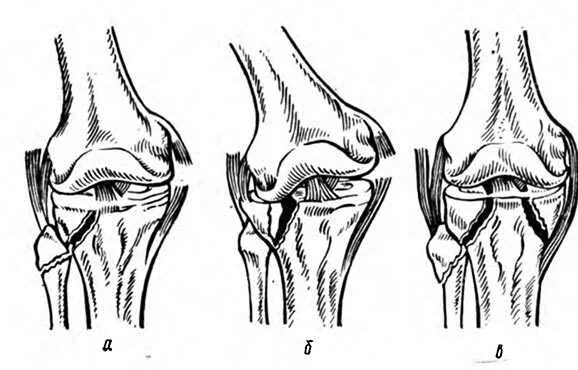 Повреждение медиального мыщелка. Внутрисуставной импрессионный перелом большеберцовой кости. Перелом мыщелков большеберцовой кости. Перелом мыщелка (мыщелков) большеберцовой кости. Внутрисуставной импрессионный перелом мыщелка.