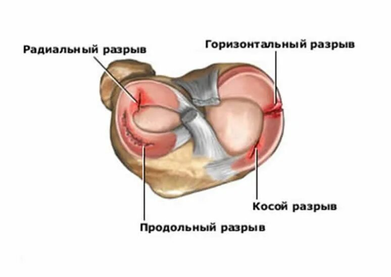 Разрыв заднего рога коленного сустава. Разрыв заднего рога медиального мениска мениска. Повреждение заднего рога мениска 3 степени. Типы мениски коленного сустава. Передний рог коленного сустава