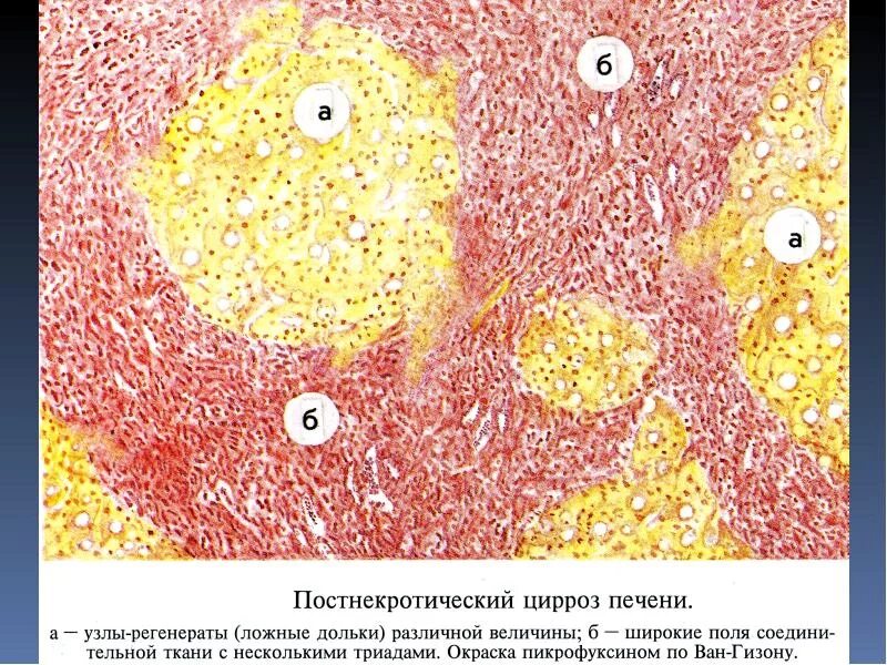 Постнекротический цирроз печени гистология. Постнекротический цирроз печени патанатомия. Портальный цирроз печени патанатомия. Постнекротический цирроз печени микропрепарат. Печень микропрепарат описание