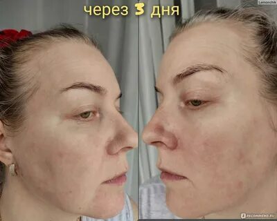 Буккальный массаж лица отзывы
