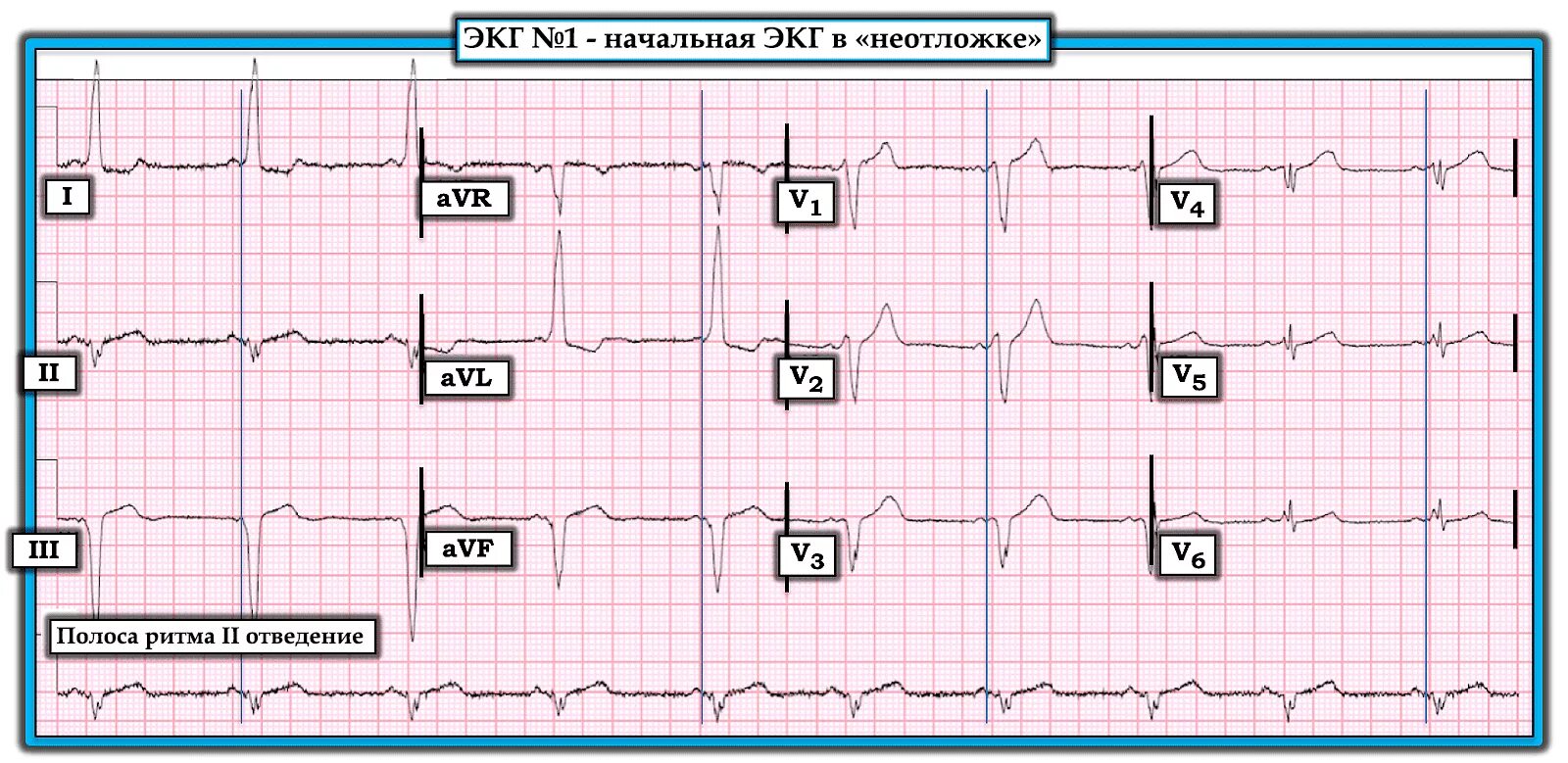 Нормальное ЭКГ В 3 отведении. AVR AVL AVF отведения на ЭКГ норма. ЭКГ норма в 12 отведениях. Нормальная ЭКГ 1 отведение. Отведение v1 на экг