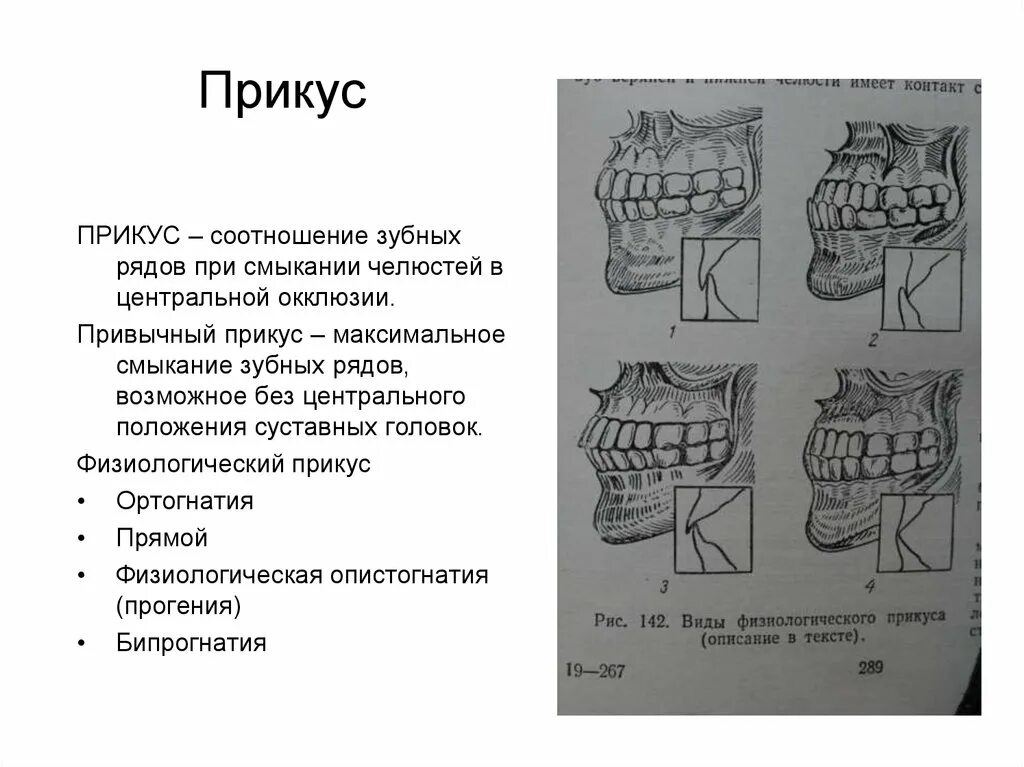 Артикуляция зубов. Артикуляция и окклюзия виды. Окклюзия и артикуляция в стоматологии. Прикусы виды характеристика. Понятие окклюзии и артикуляции.