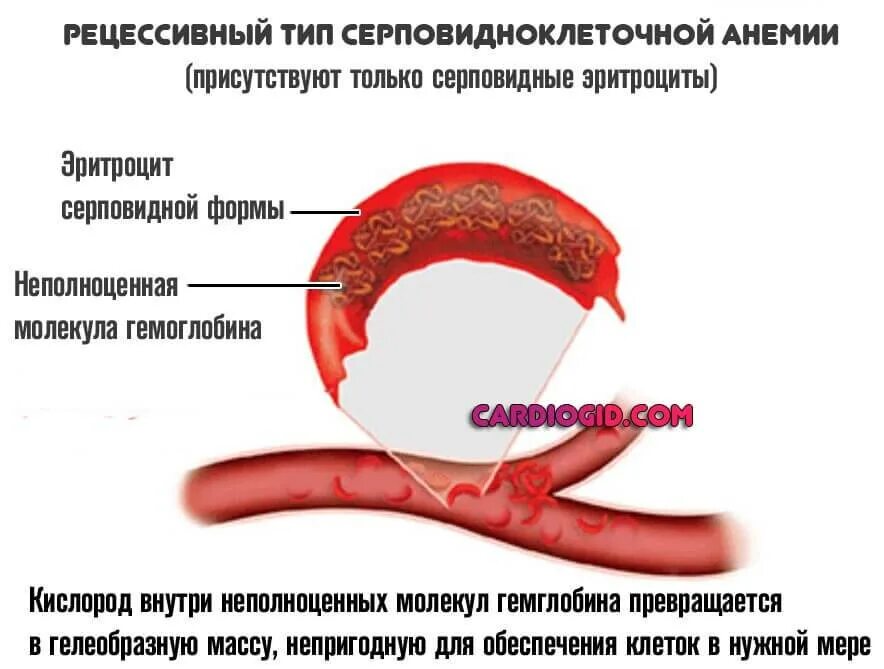 Серповидная клеточная анемия симптомы. Серповидная клеточная анемия причины. Серповидноклеточная анемия человек. Серповидноклеточная анемия причины.