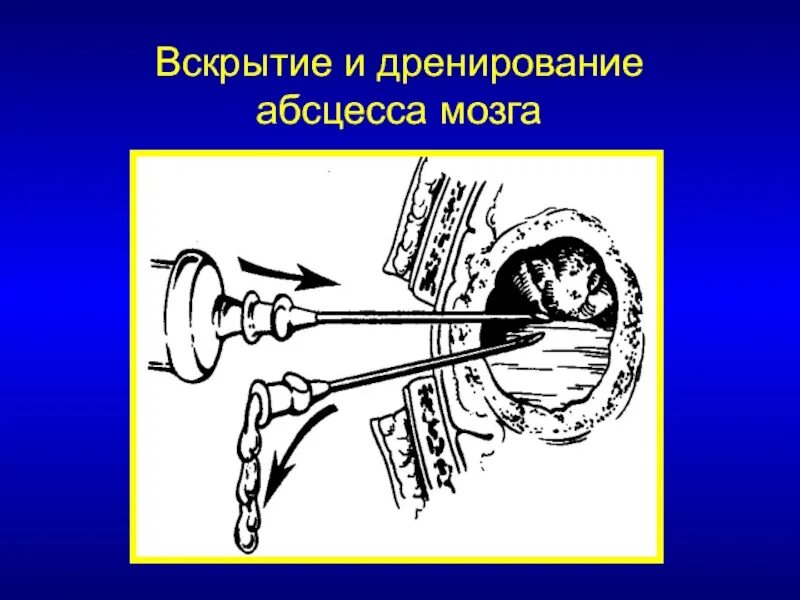 Дренаж при абсцессе. Пункционная аспирация абсцесса головного мозга. вскрытие и дренирование абсцесса. дренирование абсцесса мозга. дренирование при абсцессе.