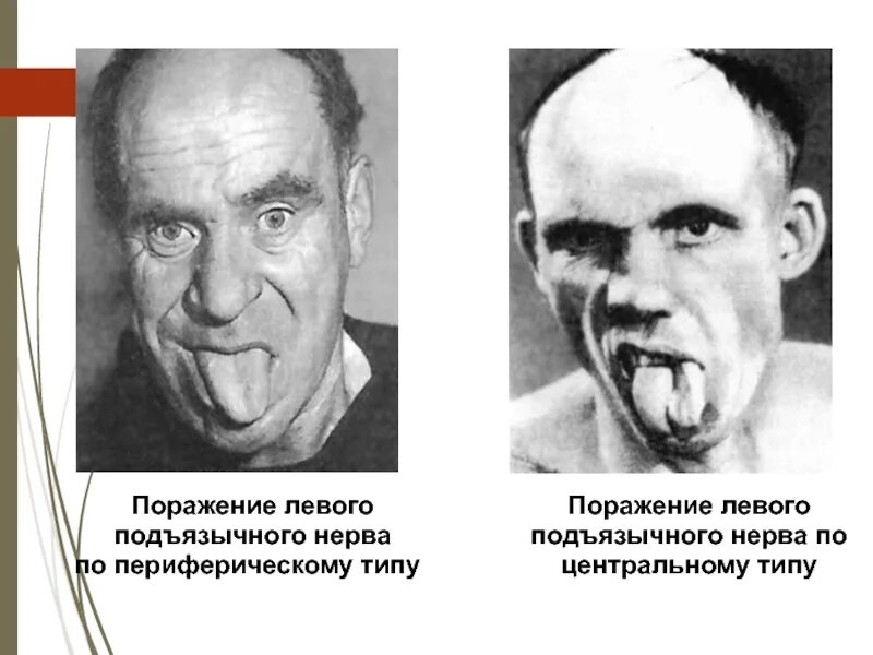 Центральный парез подъязычного нерва симптомы. Поражение левого подъязычного нерва по периферическому типу. Центральный и периферический паралич подъязычного нерва неврология. Центральный парез мышц языка. Поражение подъязычного нерва