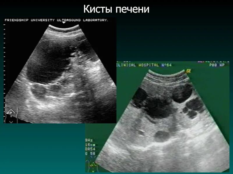 Как лечить кисту печени. Паразитарные кисты печени на узи. многокамерная киста печени.