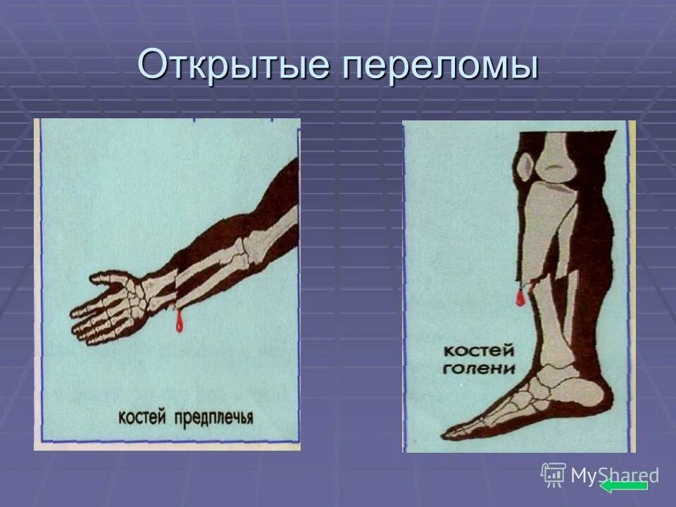 Открытый перелом костей. Открытые переломы рисунок. Вторично открытый перелом.