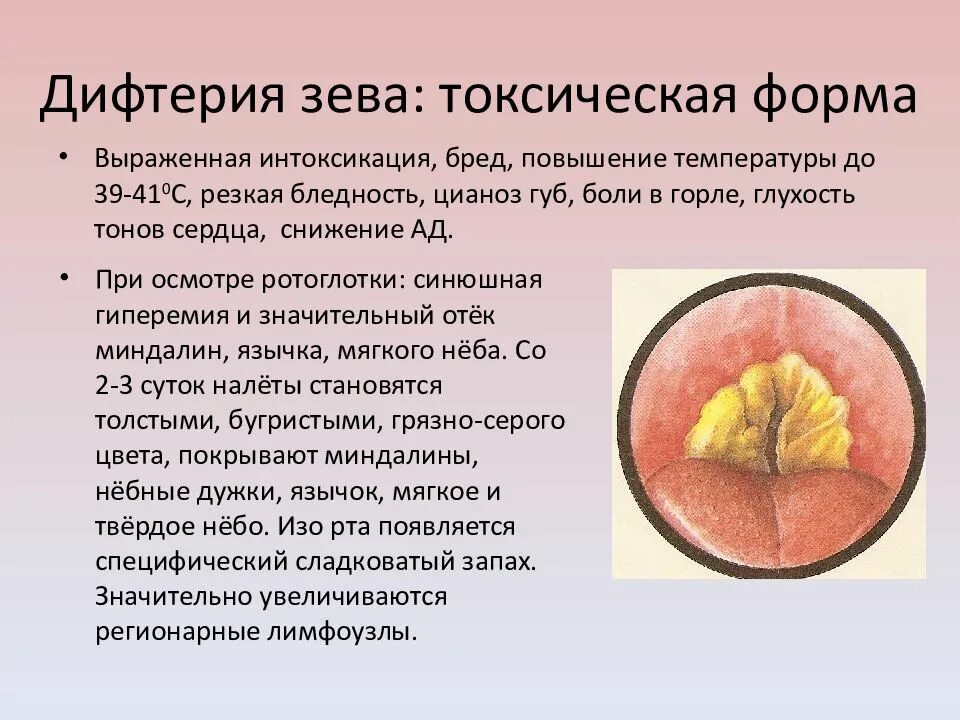 Асимметрия зева