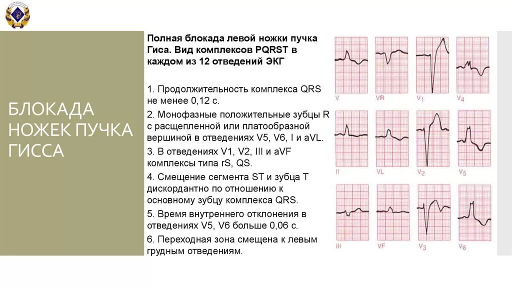 Что означает блокада правой ножки. Блокада ЛНПГ на ЭКГ. Блокада левой ножки пучка Гиса на ЭКГ. Полная и неполная блокада левой ножки пучка Гиса на ЭКГ. Преходящая блокада левой ножки пучка Гиса на Холтер ЭКГ.