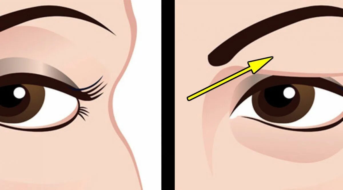 Почему веко верхнее нависло. Нависшее веко птоз. Нависание верхнего века. Наклейки для нависшего века. Опущенные веки глаз.