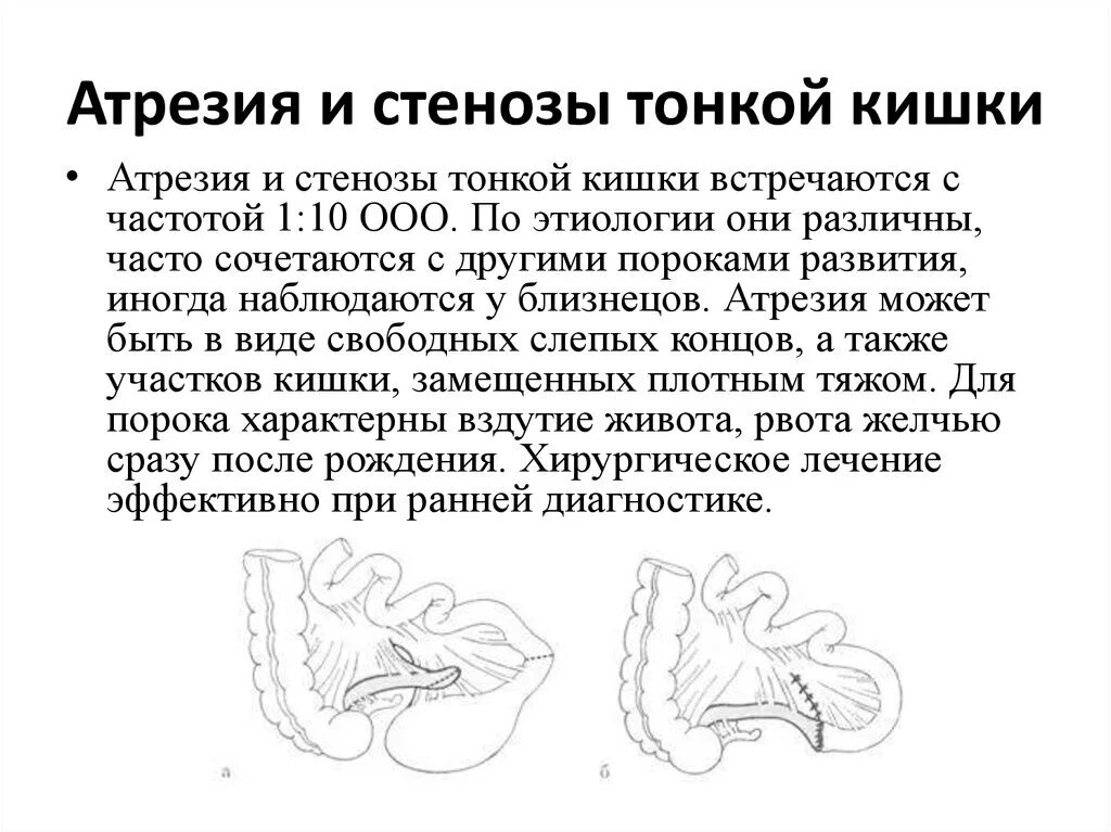 Атрезия подвздошной кишки рентген. Атрезия тонкой кишки классификация. Стеноз прямой