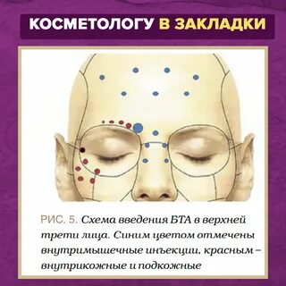 Схема ботокса
