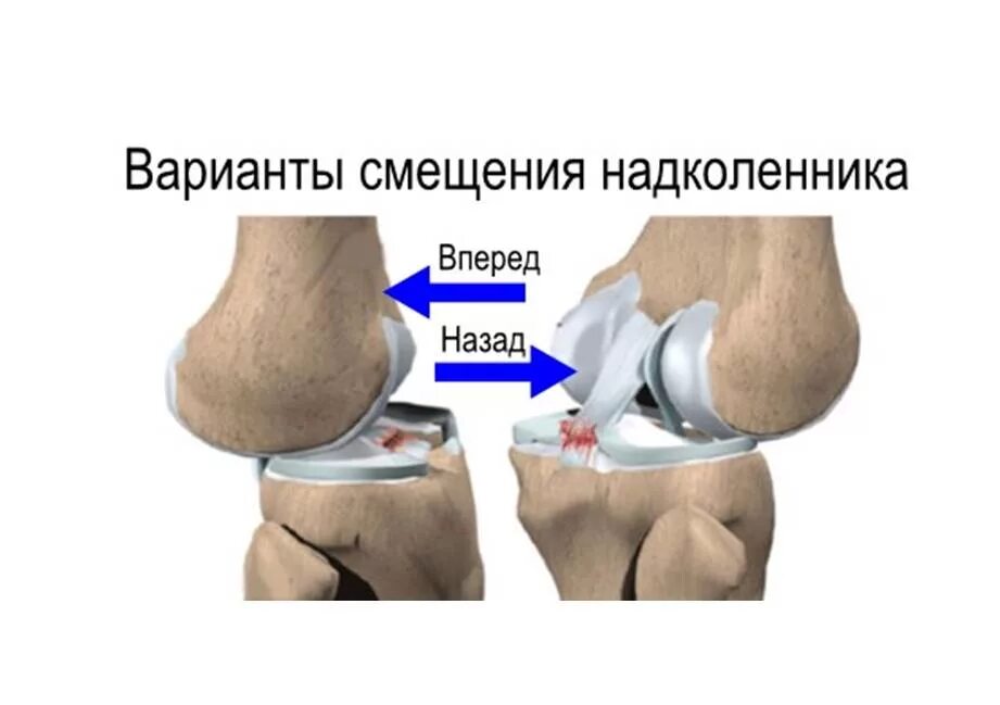 Почему вылетают суставы