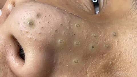 Deep Blackheads on Nose Acne Removal Acne Scar Treatment #002 - YouTube.