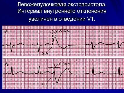 Как избавиться от экстрасистолии