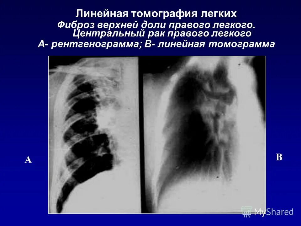 Фиброз верхней доли правого легкого. Фиброз верхушки легкого что это. Фиброз нижней доли левого легкого. Базальный легочный фиброз. Изменения в верхней доле легкого