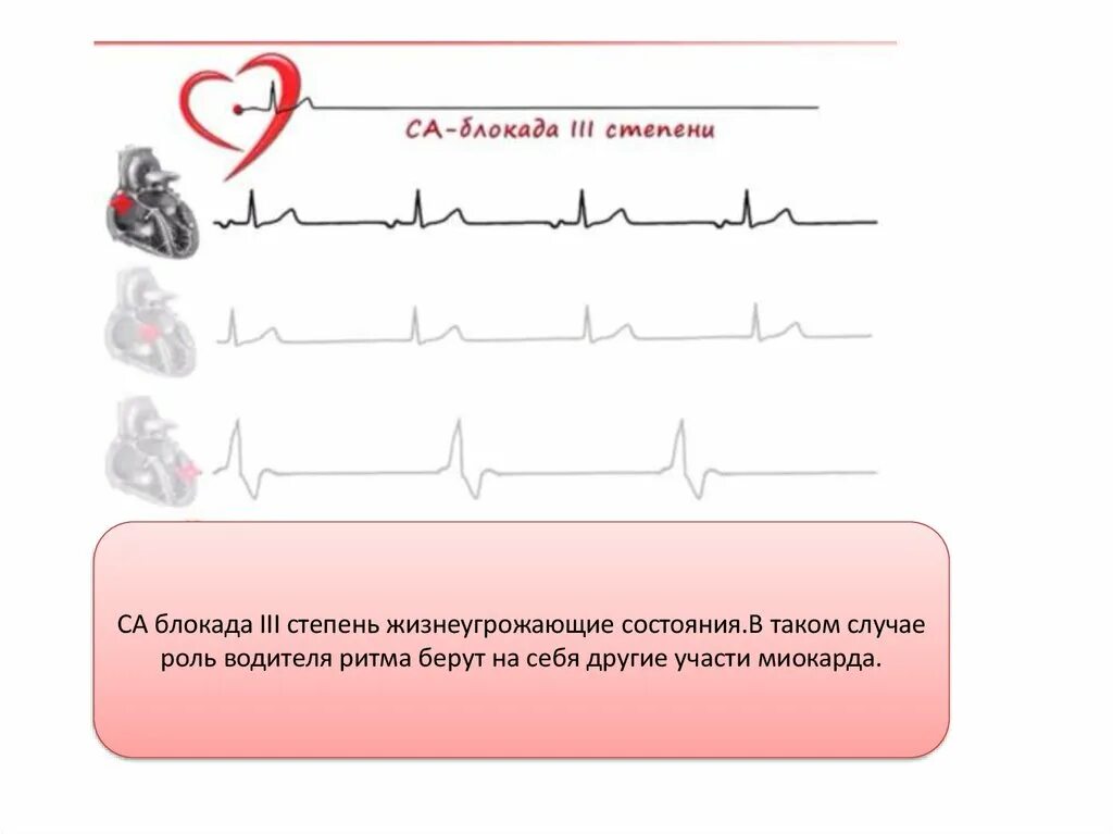 Блокада узла. Блокада са узла ЭКГ. Синоатриальная блокада 3 степени на ЭКГ. Блокада синусового узла на ЭКГ. Критерии са блокады 3 степени.