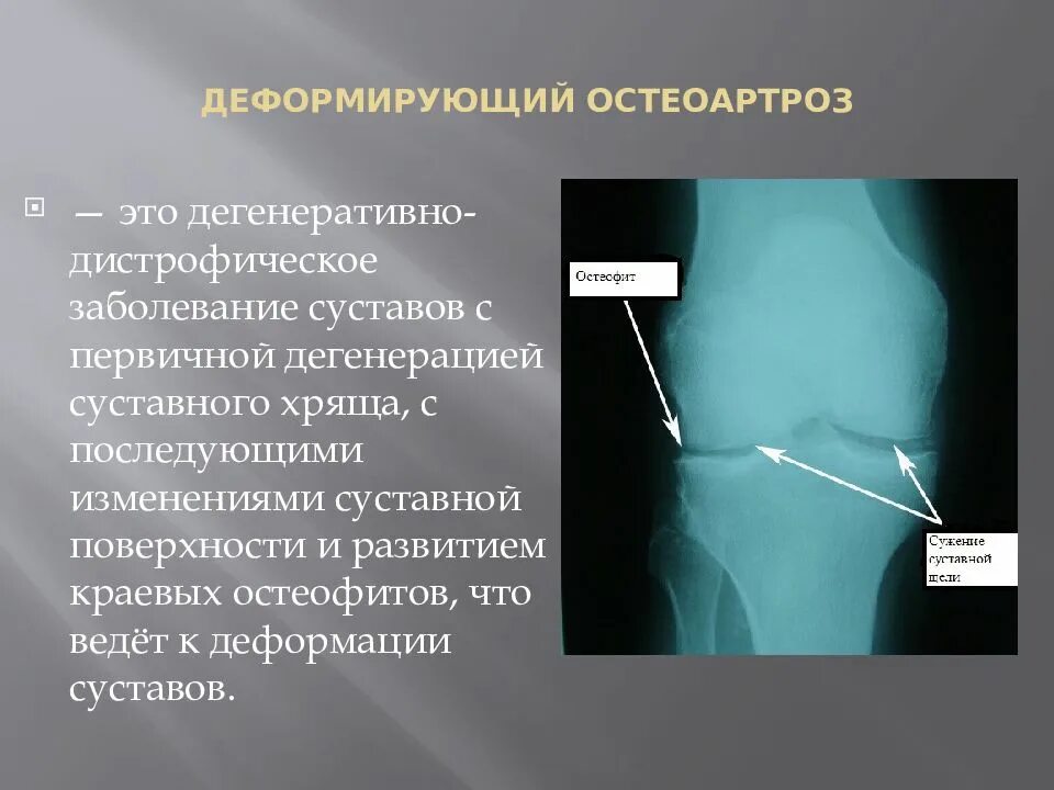 Изменение суставного хряща. Дегенерация суставного хряща это. дегенеративно-дистрофические поражения суставов. дегенеративный остеоартроз. первичный и вторичный остеоартроз.