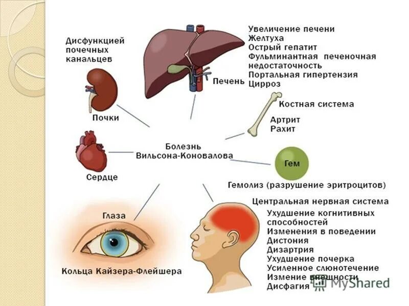 Болезнь Вильсона Коновалова поражение печени. Органы мишени при болезни Вильсона Коновалова. Болезнь Вильсона Коновалова клинические проявления. Болезнь Вильсона-Коновалова у детей патогенез. Синдром вильсона коновалова что это такое простыми