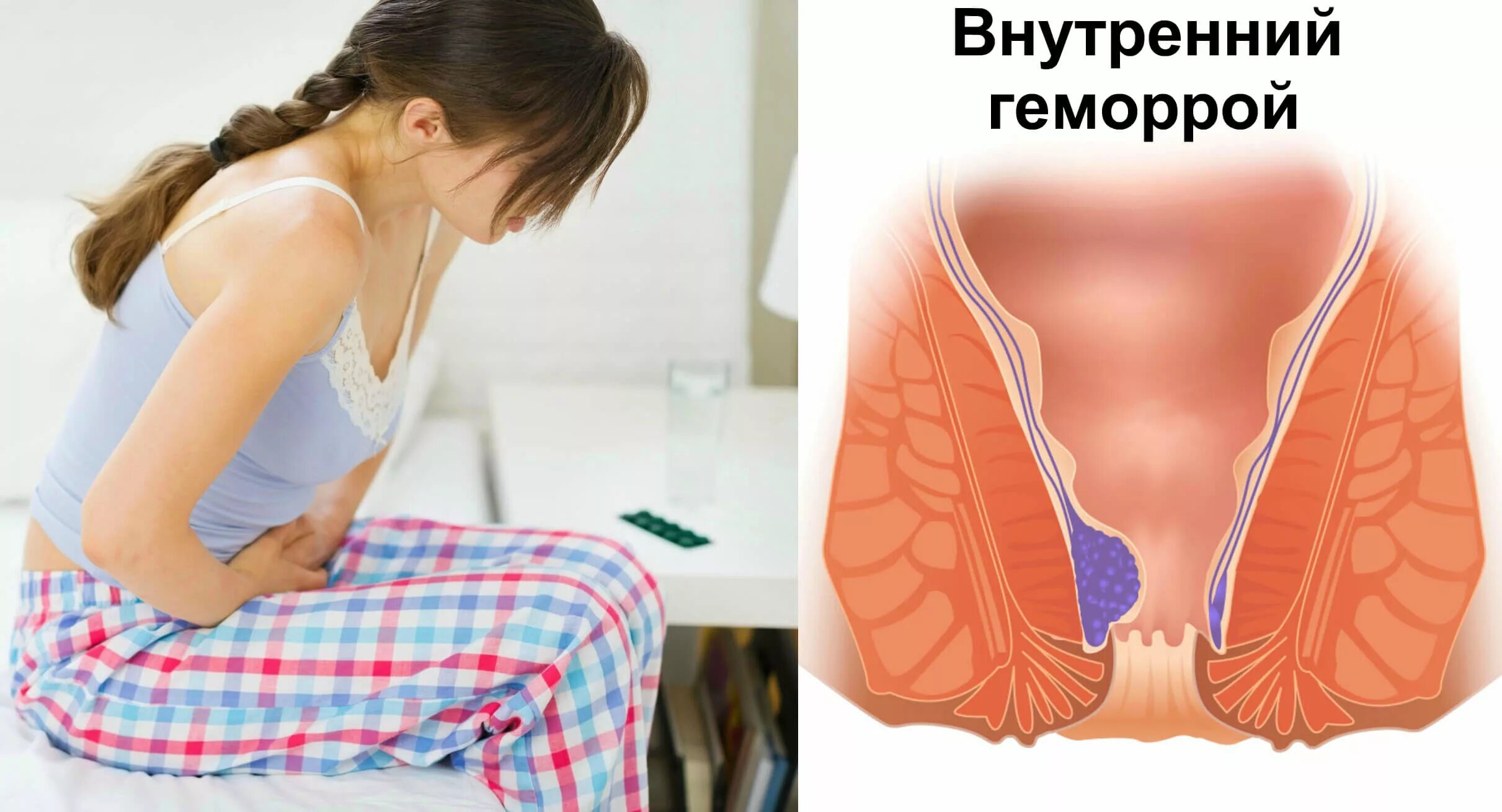 Как вылечить геморрой. Как вылечить геморрой