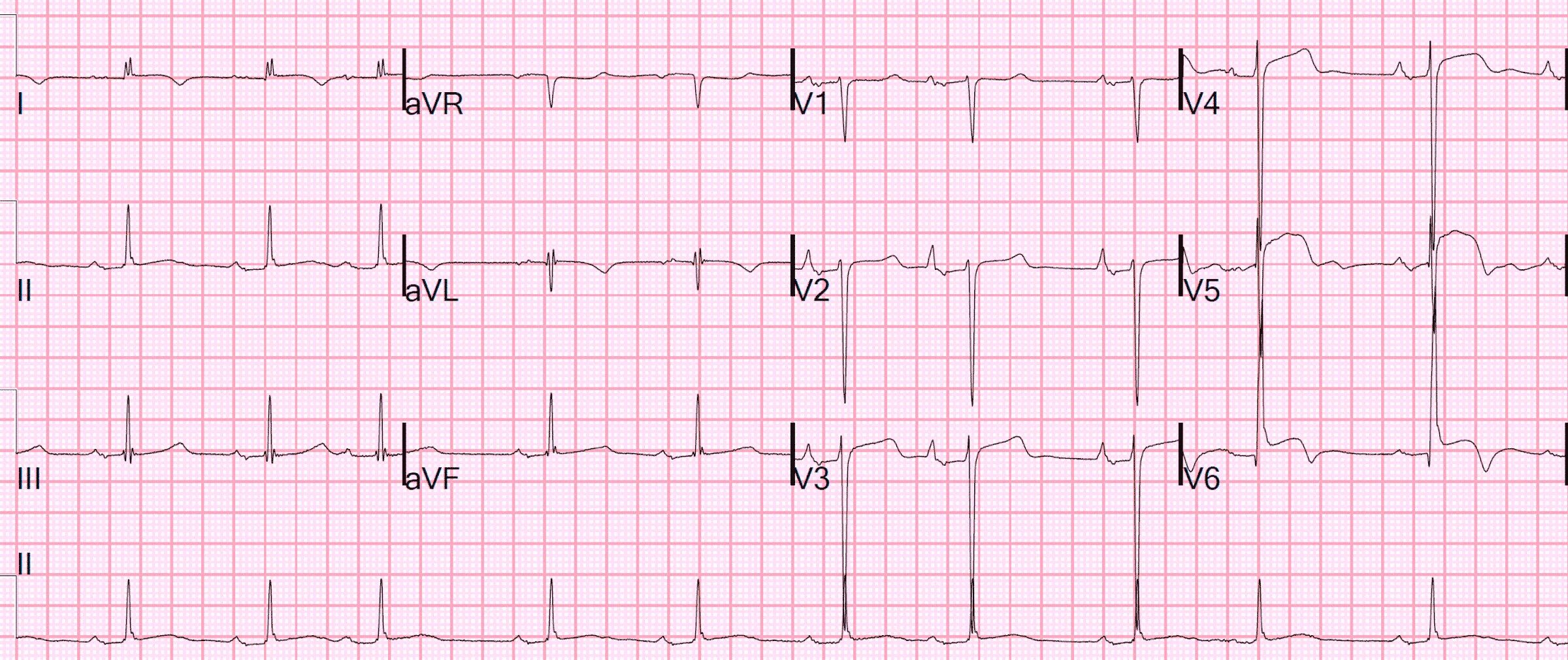 Мв на экг. STEMI на ЭКГ. ЭКГ Узловой ритм инфаркт. Интервал рр на ЭКГ. Интервал r r в ЭКГ.