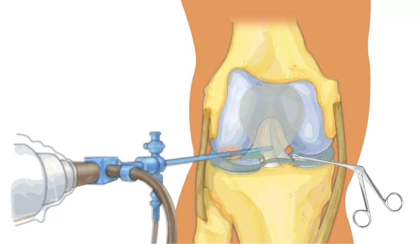 Операция артроскопия коленного. Артроскопическая резекция мениска. Артроскопия связок коленного сустава. Операция артроскопия коленного сустава. Мениск коленного сустава лечение в домашних условиях