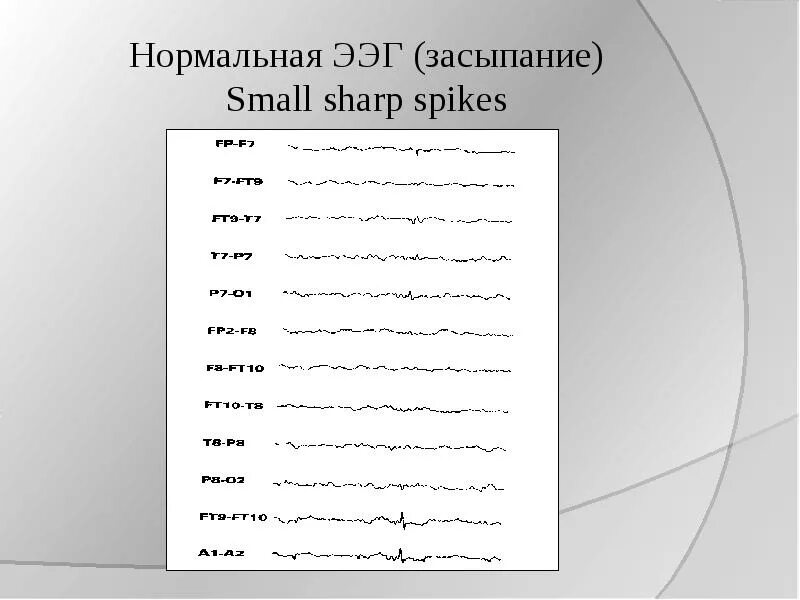 Спайк на ээг. Расположение электродов ЭЭГ. Sharp ЭЭГ. Спайки на ЭЭГ. Детектор ЭЭГ схема.