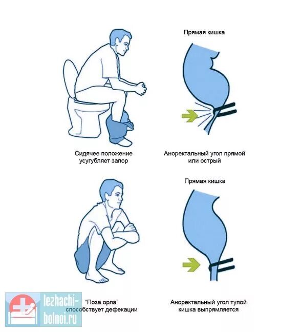 Запор. Правильная поза для опорожнения. Поза для опорожнения кишечника.