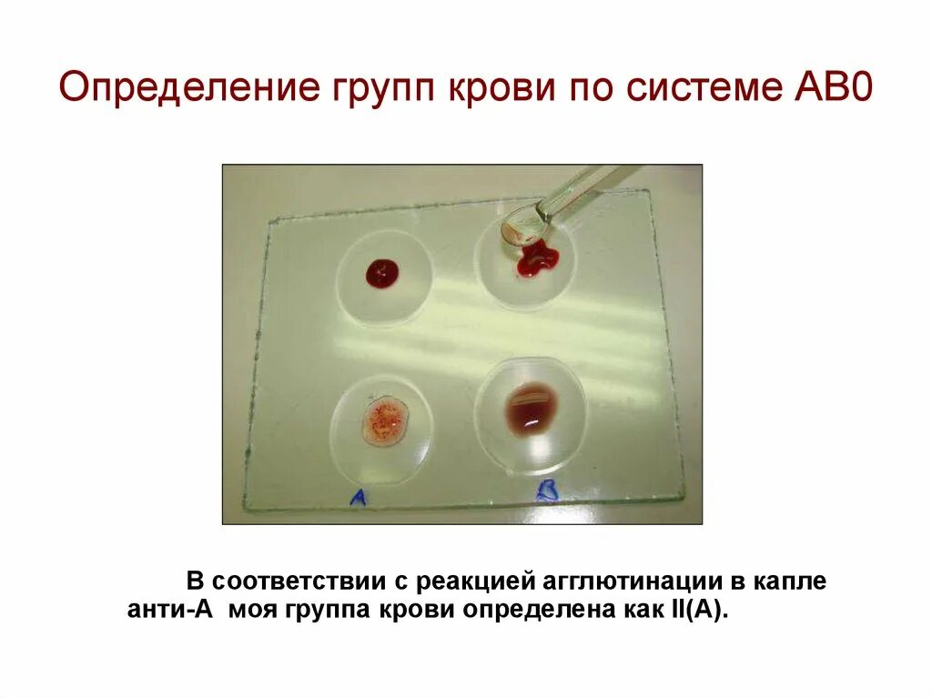 Агглютинация по группам крови. Определение группы крови. Реакция определения группы крови. Методика определения группы крови. Как отличить кровь