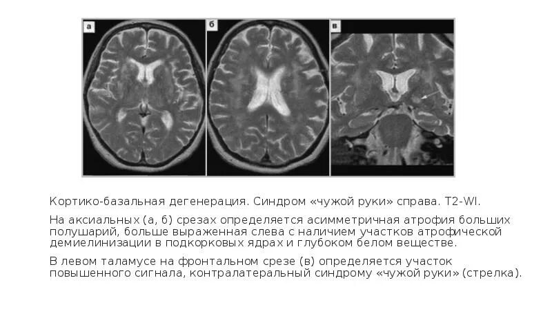 Дегенерация головного. Кортикобазальная дегенерация. Кортико базальная дегенерация. Кортикобазальная дегенерация мрт. Кортико базальная дегенерация головного мозга.