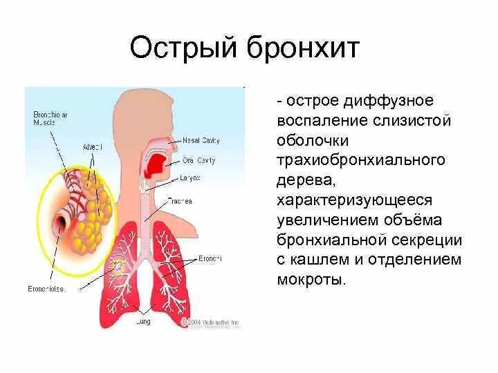 Бронхит бронхи. Воспаление слизистой оболочки бронхов. Острыйси хронический бронхит. Острый и хронический бронхит.