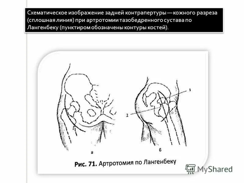артротомия тазобедренного сустава. парапателлярная артротомия коленного сустава. артротомия плечевого сустава по лангенбеку.