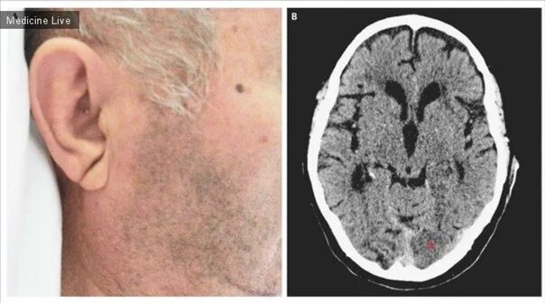 The patient was noted to have bilateral Frank's sign, ... GrepMed
