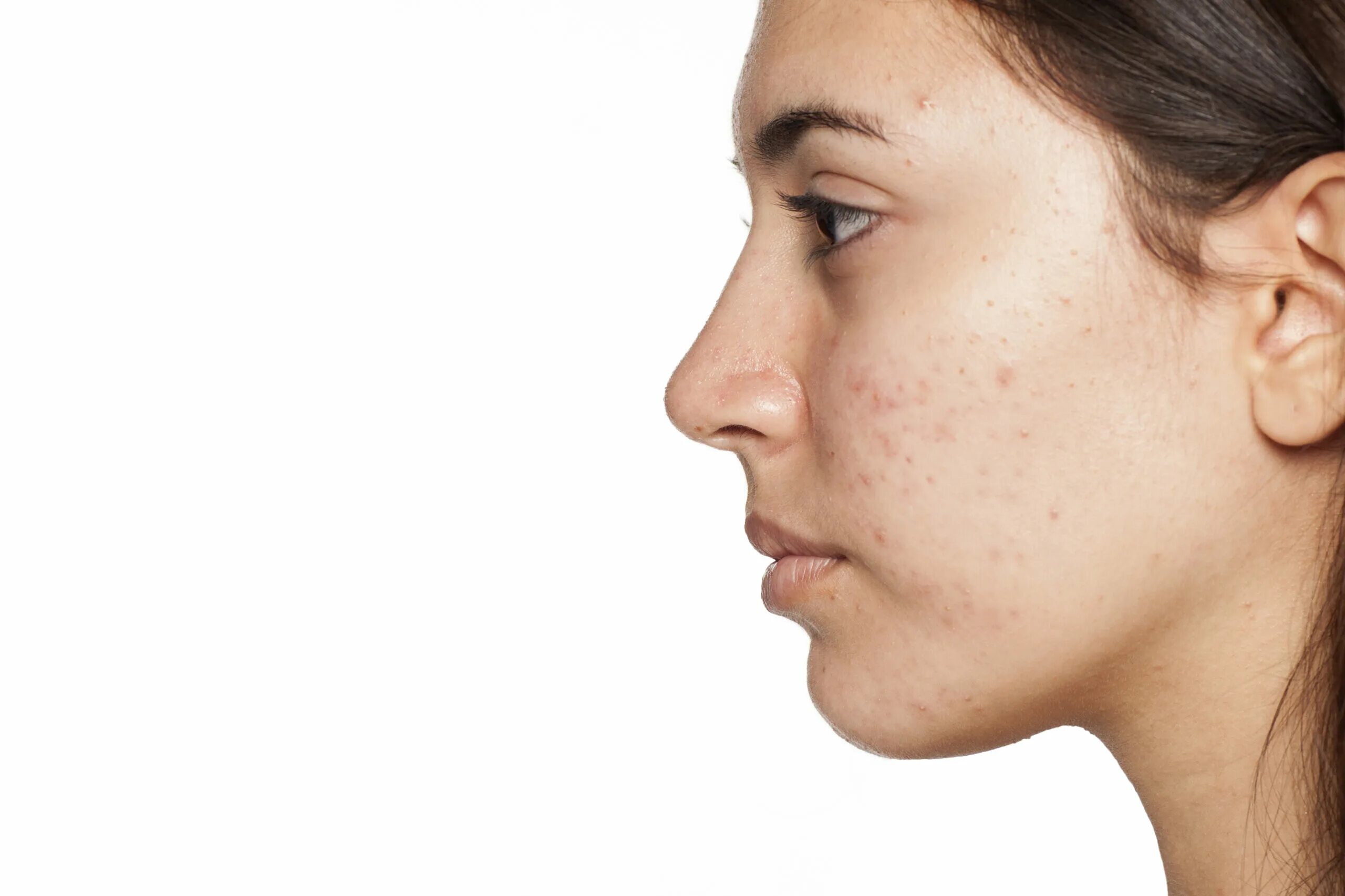 Acne pimple. Acne pimple